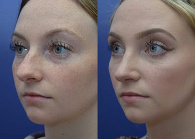 Rhinoplasty (Nose Reshaping) Before & After Gallery - Patient 30353997 - Image 2