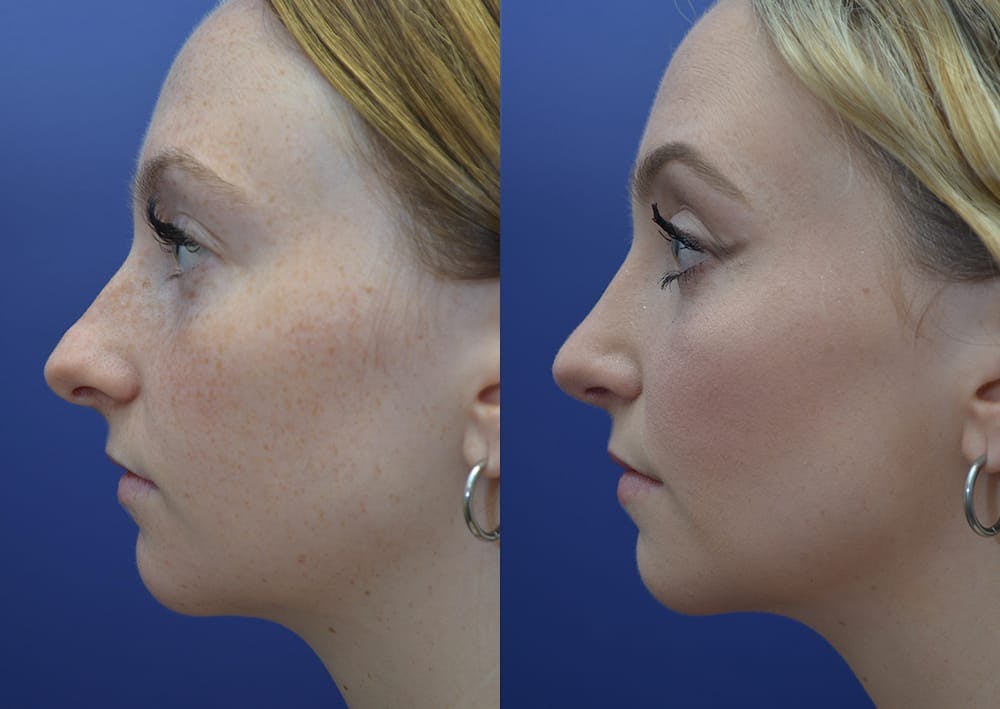 Rhinoplasty (Nose Reshaping) Before & After Gallery - Patient 30353997 - Image 3