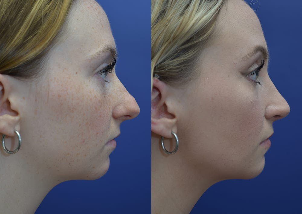 Rhinoplasty (Nose Reshaping) Before & After Gallery - Patient 30353997 - Image 5