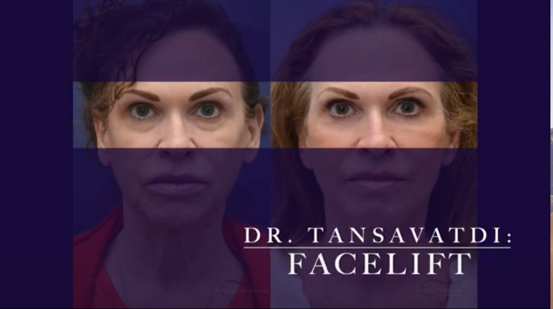 facelift before and after image highlighting the eyes