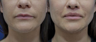Lip Augmentation Before & After Gallery - Patient 35314152 - Image 1