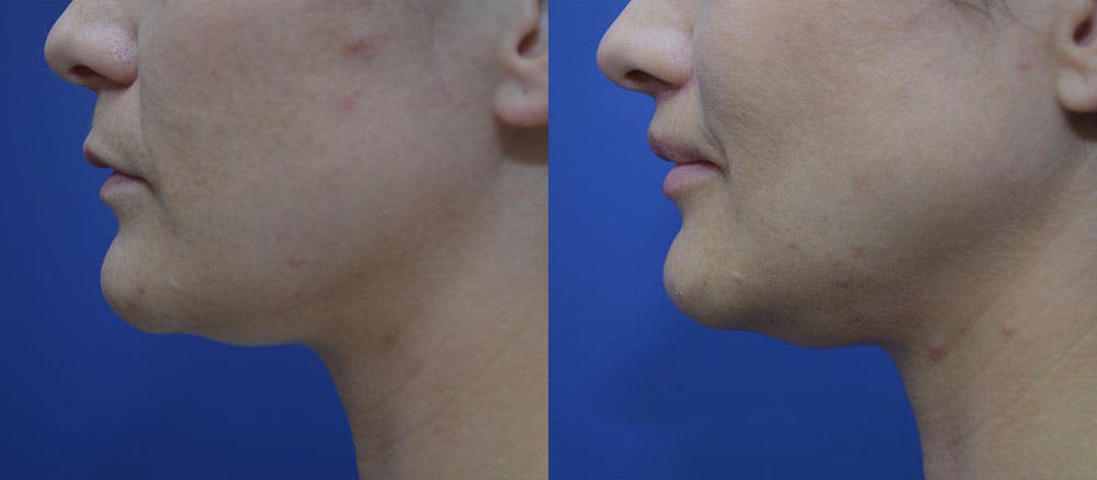 Lip Augmentation Before & After Gallery - Patient 35314152 - Image 2