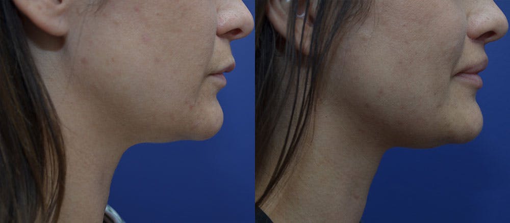 Lip Augmentation Before & After Gallery - Patient 35314152 - Image 3