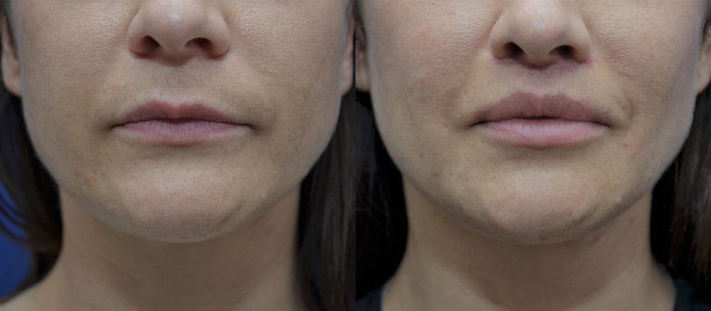 Lip Lift Before & After Gallery - Patient 35329647 - Image 1