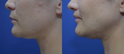 Lip Lift Before & After Gallery - Patient 35329647 - Image 2