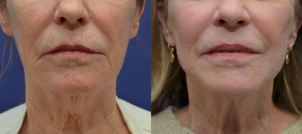 Deep Plane Facelift Before & After Gallery - Patient 40632571 - Image 5