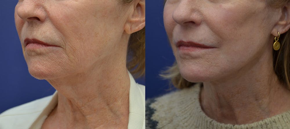 Deep Plane Facelift Before & After Gallery - Patient 40632571 - Image 1