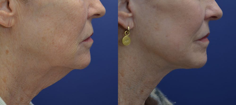 Deep Plane Facelift Before & After Gallery - Patient 40632571 - Image 3