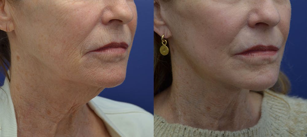 Facelift Before & After Gallery - Patient 40632571 - Image 4