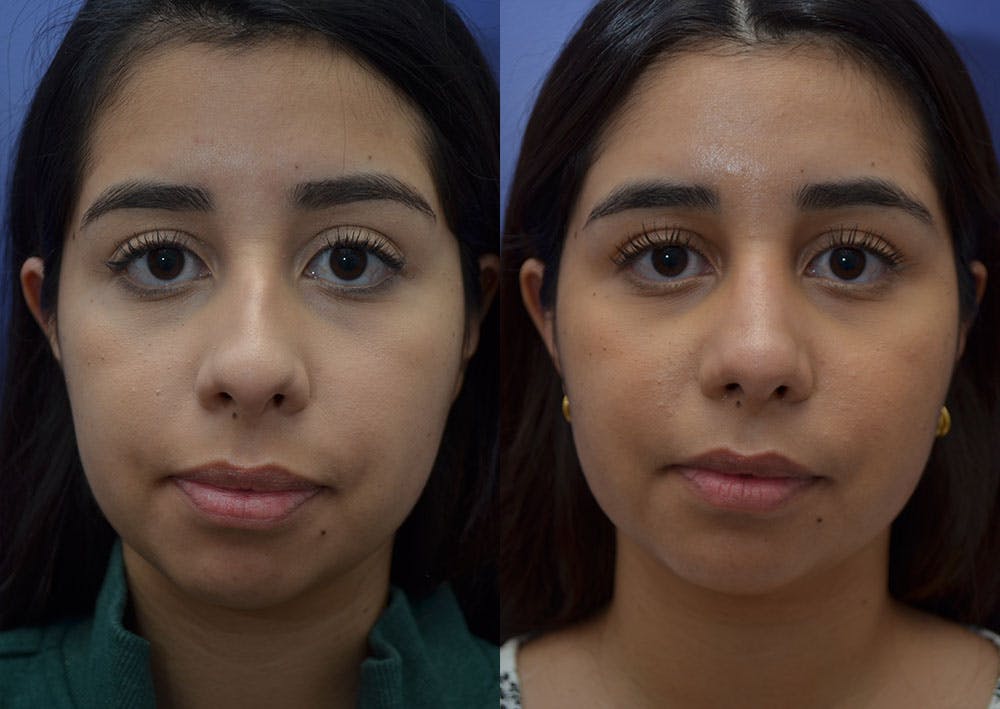 Rhinoplasty (Nose Reshaping) Before & After Gallery - Patient 41510132 - Image 5