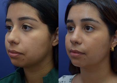Rhinoplasty (Nose Reshaping) Before & After Gallery - Patient 41510132 - Image 1