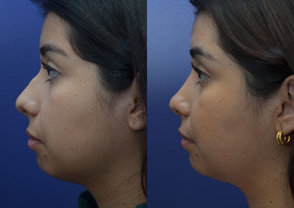 Rhinoplasty (Nose Reshaping) Before & After Gallery - Patient 41510132 - Image 3