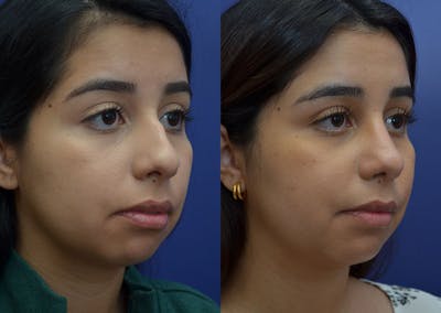 Rhinoplasty (Nose Reshaping) Before & After Gallery - Patient 41510132 - Image 2