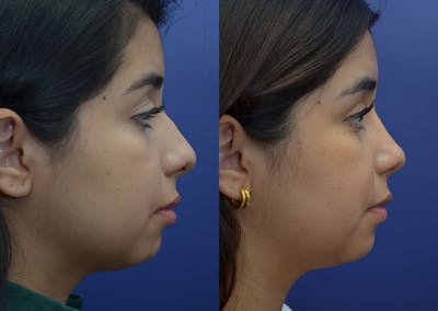 Rhinoplasty (Nose Reshaping) Before & After Gallery - Patient 41510132 - Image 4