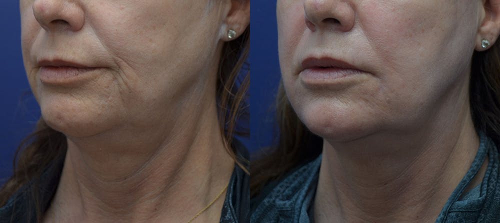 Dermabrasion / Chemical Peel Before & After Gallery - Patient 41510166 - Image 2