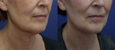 Neck Lift Before & After Gallery - Patient 41510217 - Image 2