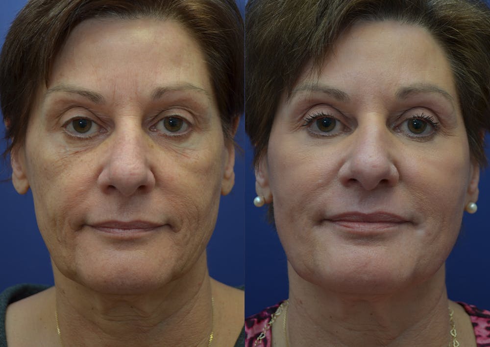 Non-Surgical Soft Tissue Fillers Gallery - Patient 44238065 - Image 1
