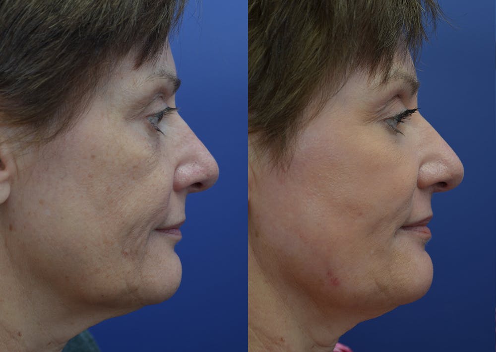 Non-Surgical Soft Tissue Fillers Before & After Gallery - Patient 44238065 - Image 5
