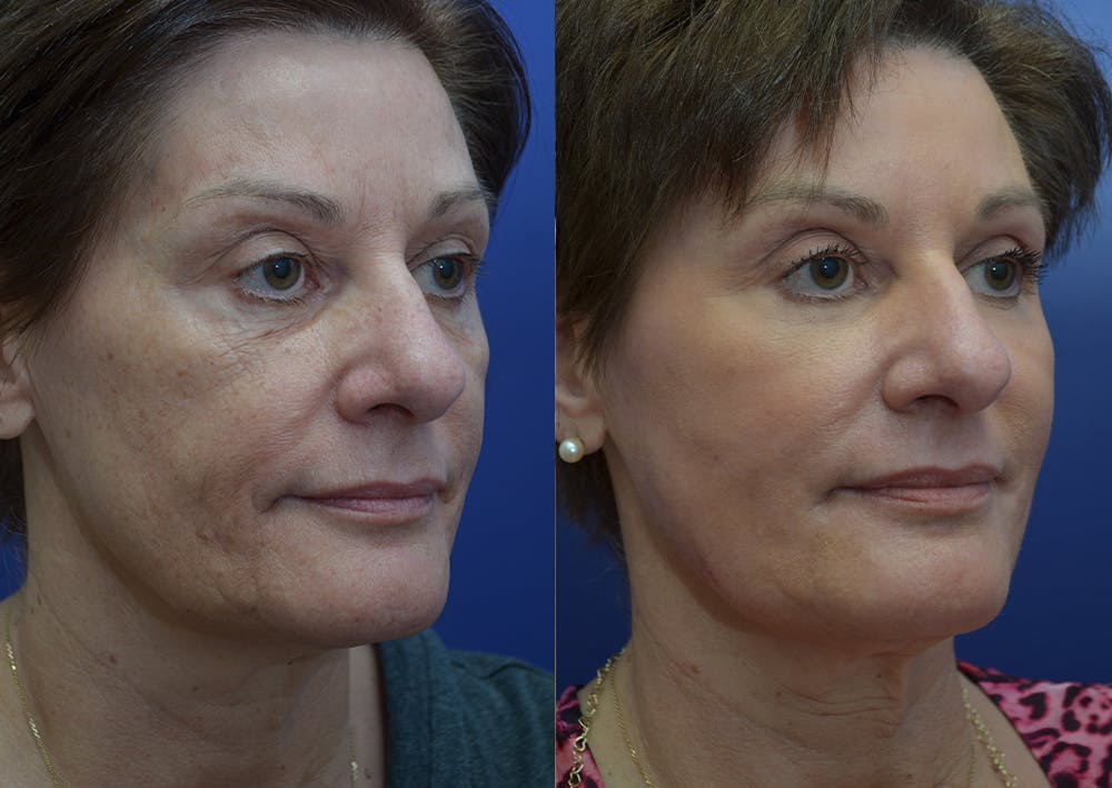 CO2 Laser Resurfacing Before & After Gallery - Patient 44238076 - Image 4