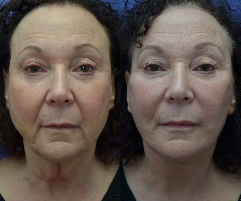 Neck Lift Before & After Gallery - Patient 45664911 - Image 3