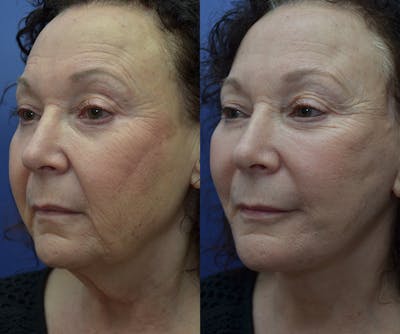 Deep Plane Neck Lift Before & After Gallery - Patient 45664911 - Image 4