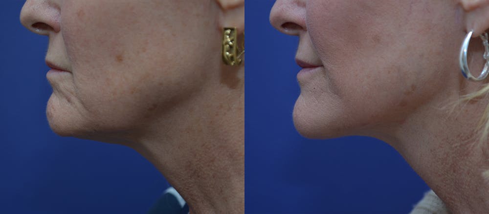 Deep Plane Neck Lift Before & After Gallery - Patient 45664910 - Image 3