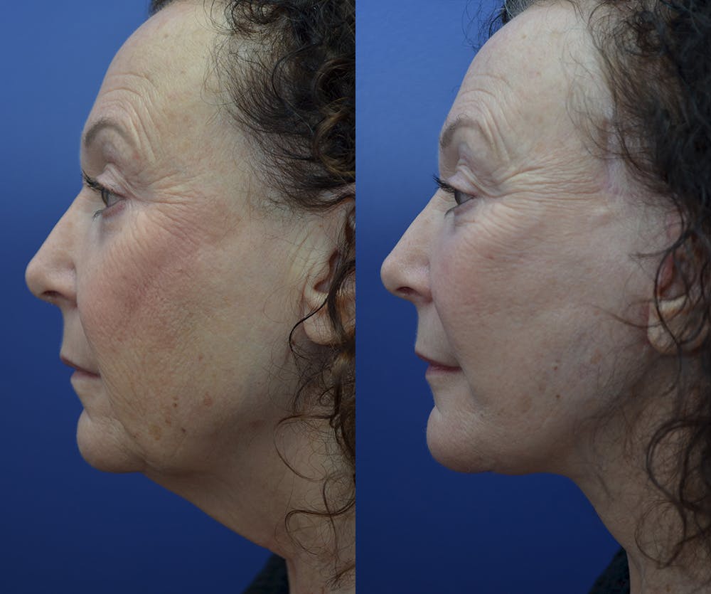 Neck Lift Before & After Gallery - Patient 45664911 - Image 5