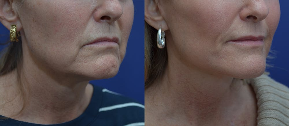 Neck Lift Before & After Gallery - Patient 45664910 - Image 2
