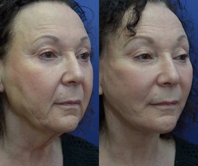 Neck Lift Before & After Gallery - Patient 45664911 - Image 2
