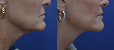 Deep Plane Neck Lift Before & After Gallery - Patient 45664910 - Image 1