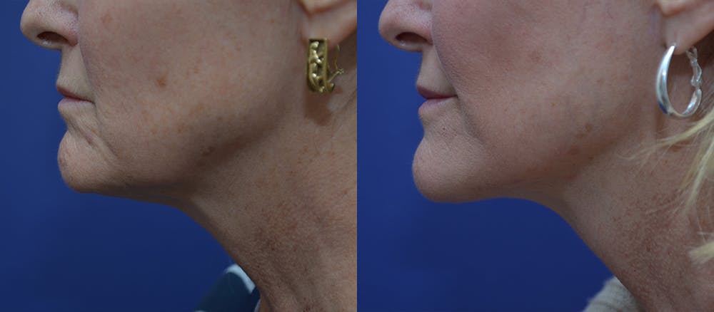 Facelift Before & After Gallery - Patient 44237761 - Image 2
