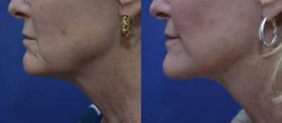 Facelift Before & After Gallery - Patient 44237761 - Image 2
