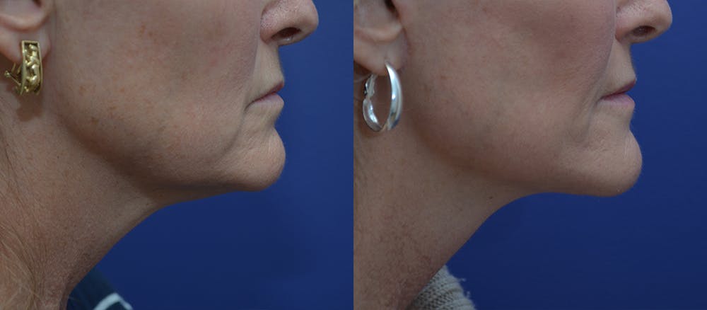 Deep Plane Facelift Before & After Gallery - Patient 44237761 - Image 3