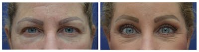 Eyelid Surgery Before & After Gallery - Patient 49141910 - Image 1