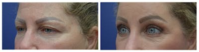 Eyelid Surgery Before & After Gallery - Patient 49141910 - Image 2