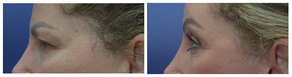 Eyelid Surgery Before & After Gallery - Patient 49141910 - Image 3