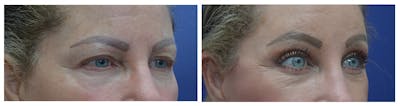 Eyelid Surgery Before & After Gallery - Patient 49141910 - Image 4