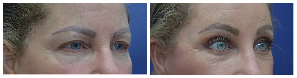 Eyelid Surgery Before & After Gallery - Patient 49141910 - Image 4