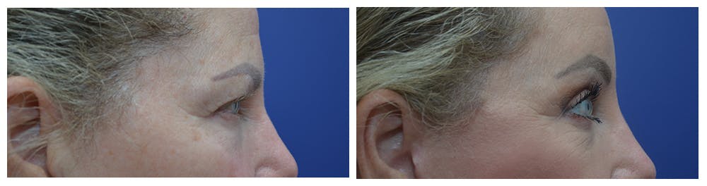 Eyelid Surgery Before & After Gallery - Patient 49141910 - Image 5
