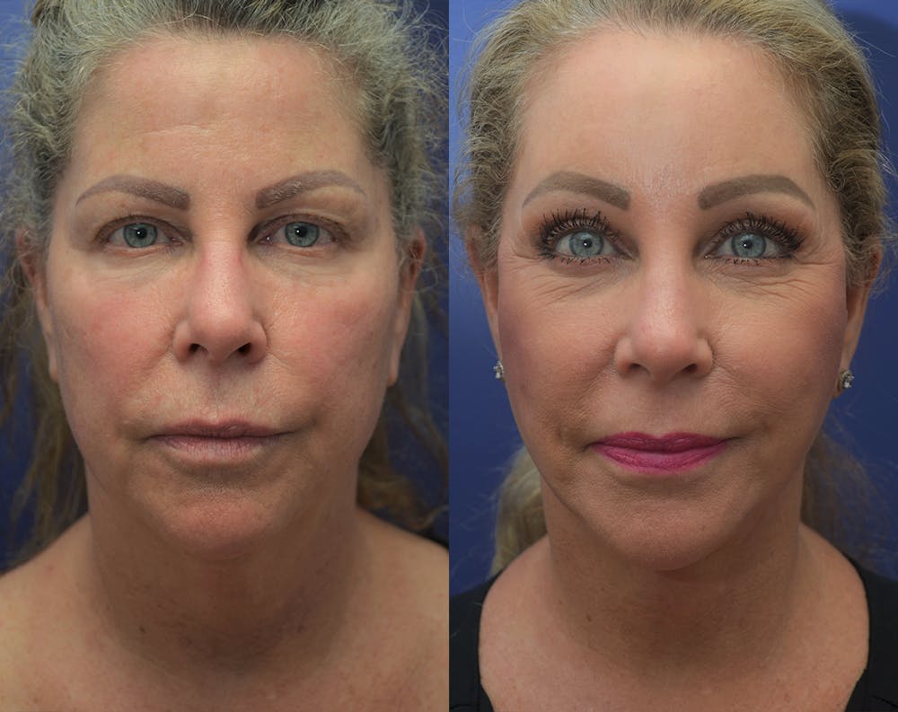 Deep Plane Facelift Before & After Gallery - Patient 50993077 - Image 5
