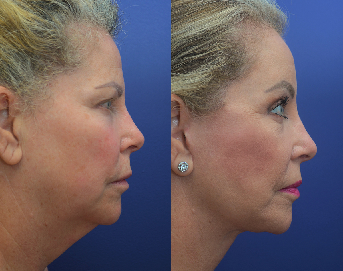 Patient 50993077 | Facelift Gallery | Tansavatdi Facial Plastic