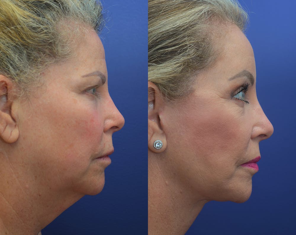 Deep Plane Facelift Before & After Gallery - Patient 50993077 - Image 3