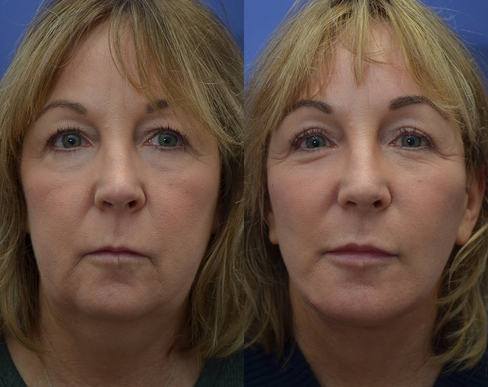 Deep Plane Facelift Before & After Gallery - Patient 50993096 - Image 3