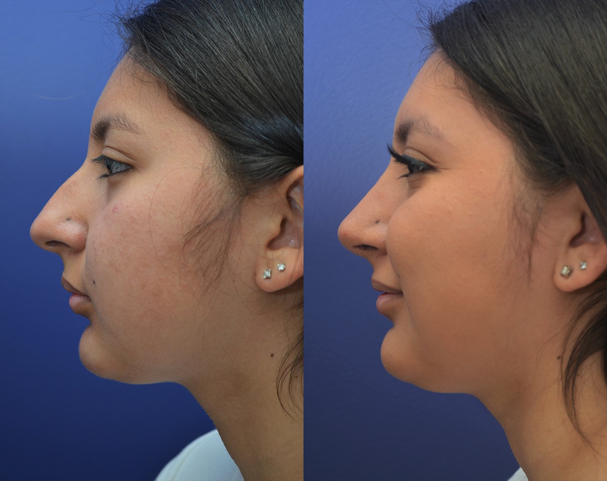 rhinoplasty before and after image 3