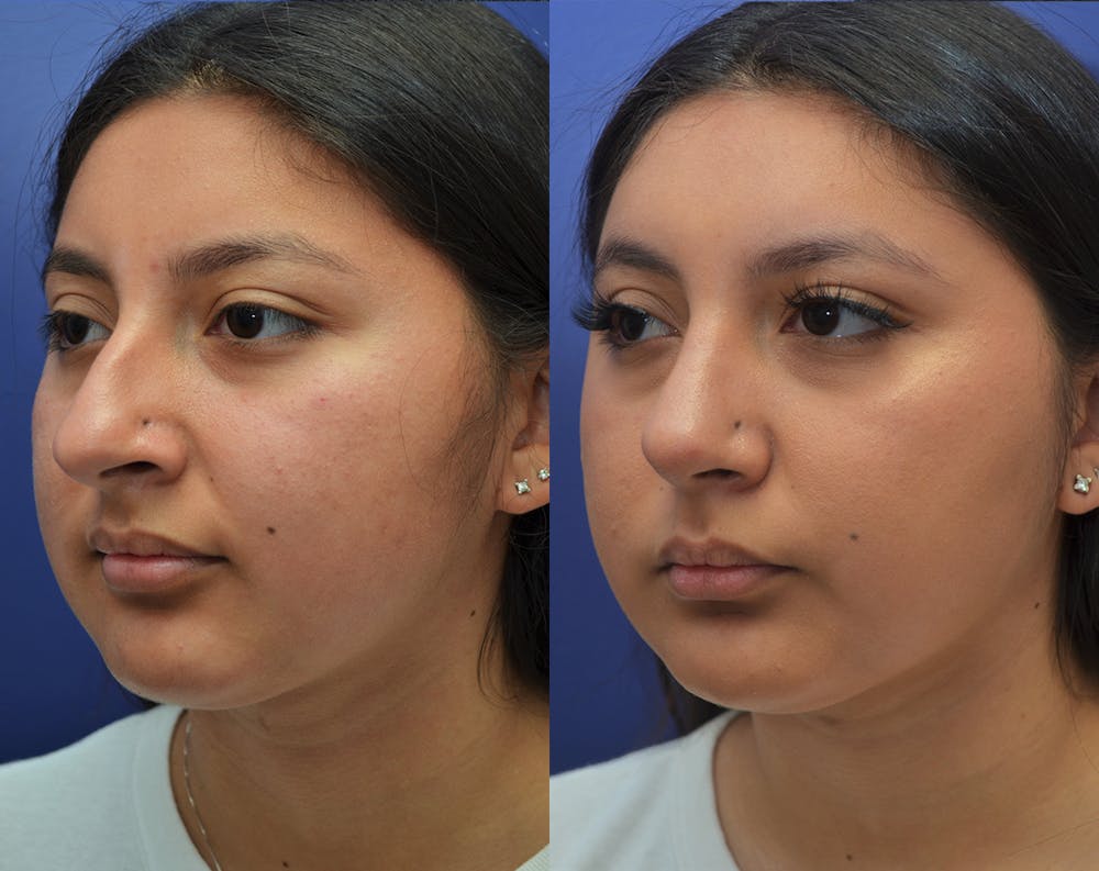 Rhinoplasty (Nose Reshaping) Before & After Gallery - Patient 50993171 - Image 2