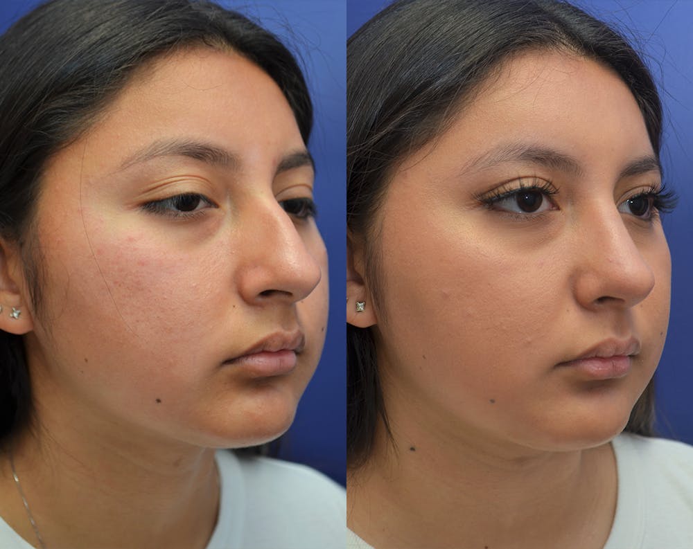 Rhinoplasty (Nose Reshaping) Before & After Gallery - Patient 50993171 - Image 3