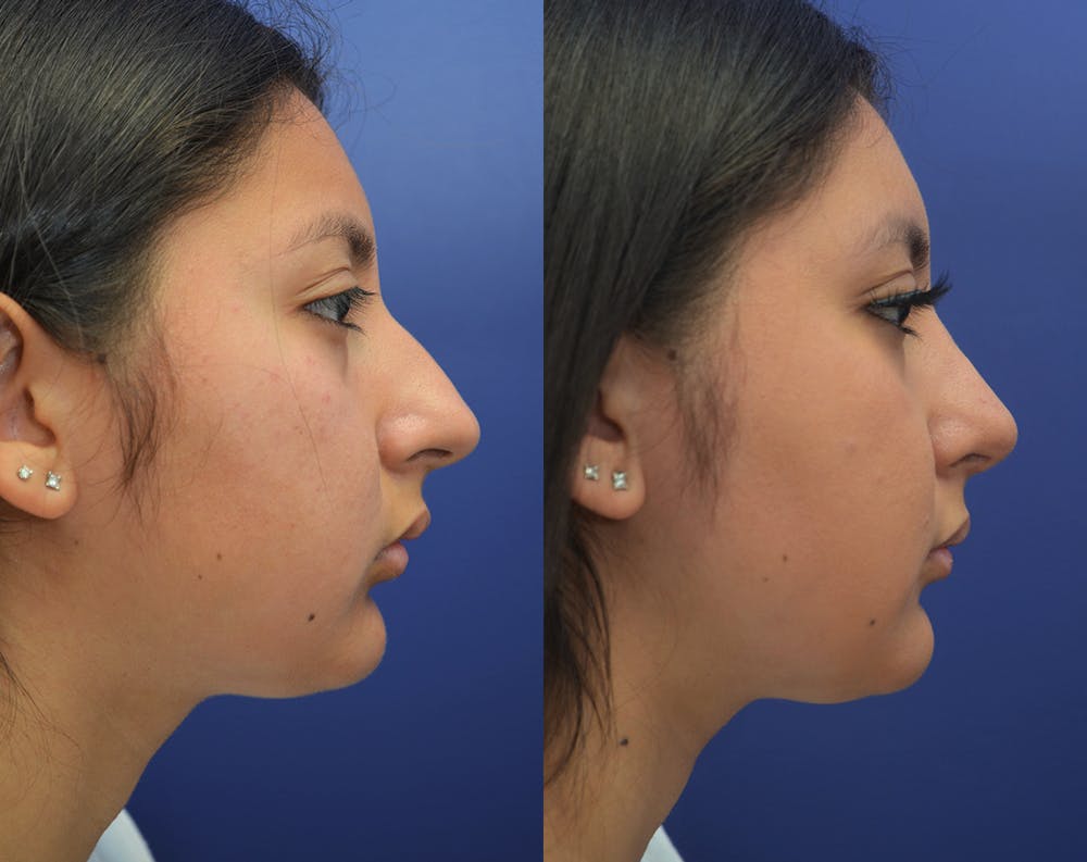 Rhinoplasty (Nose Reshaping) Before & After Gallery - Patient 50993171 - Image 4