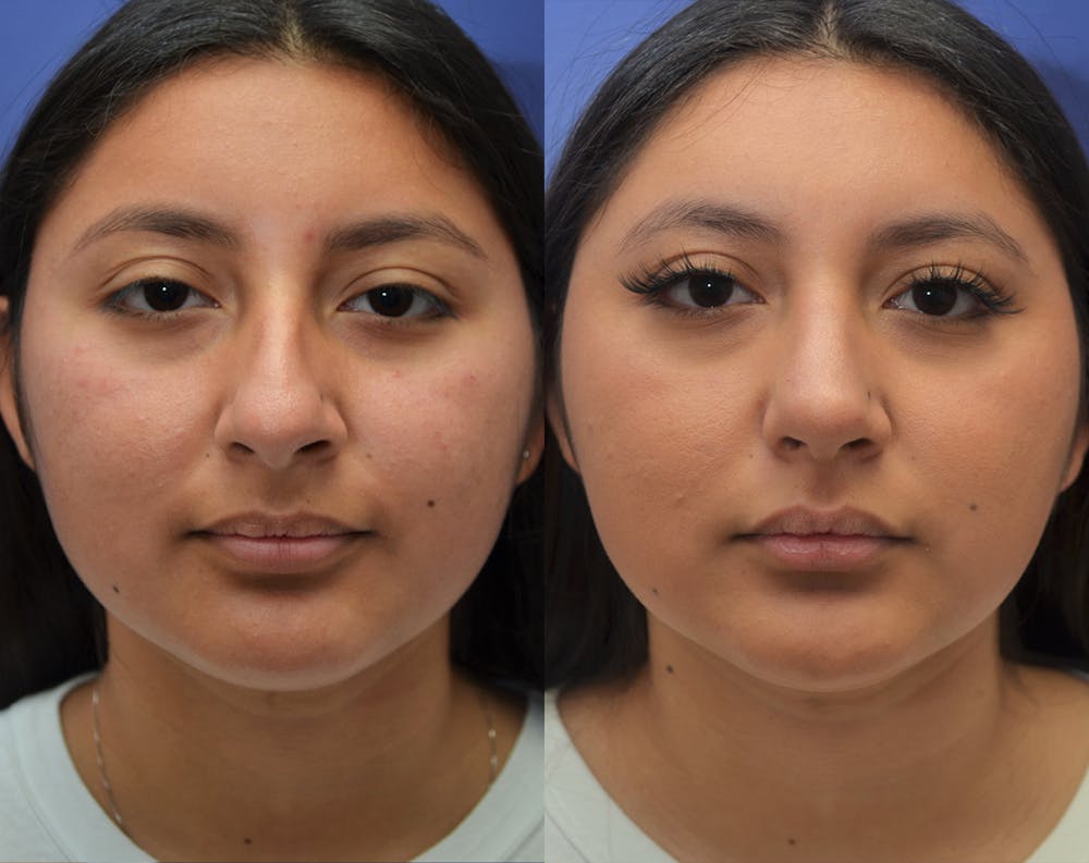Rhinoplasty (Nose Reshaping) Before & After Gallery - Patient 50993171 - Image 5