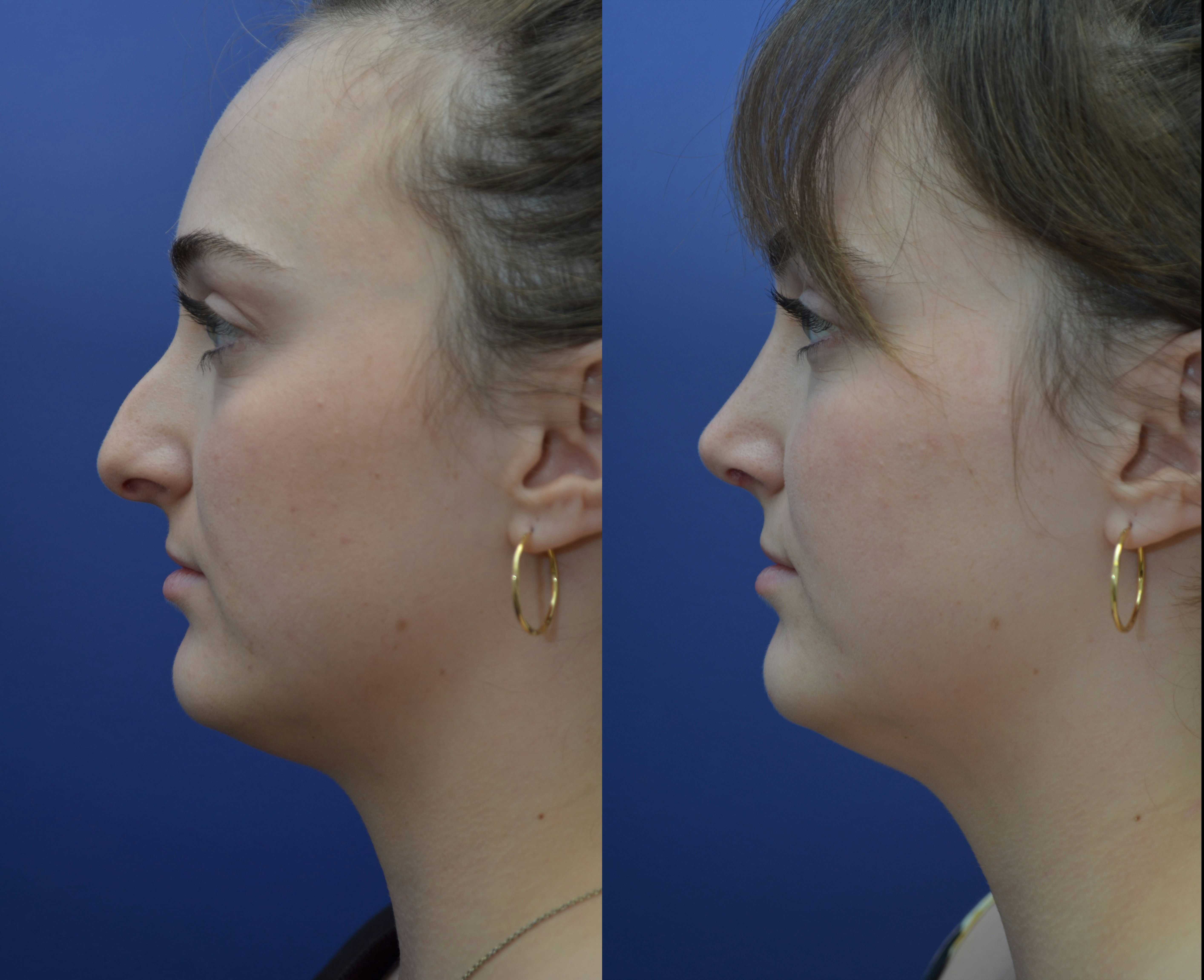 rhinoplasty before and after image 1