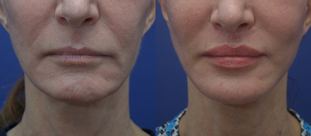 Lip Lift Before & After Gallery - Patient 23053128 - Image 1